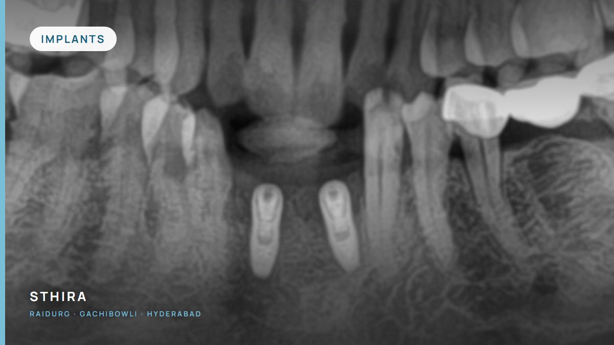 What a dental implant actually involves