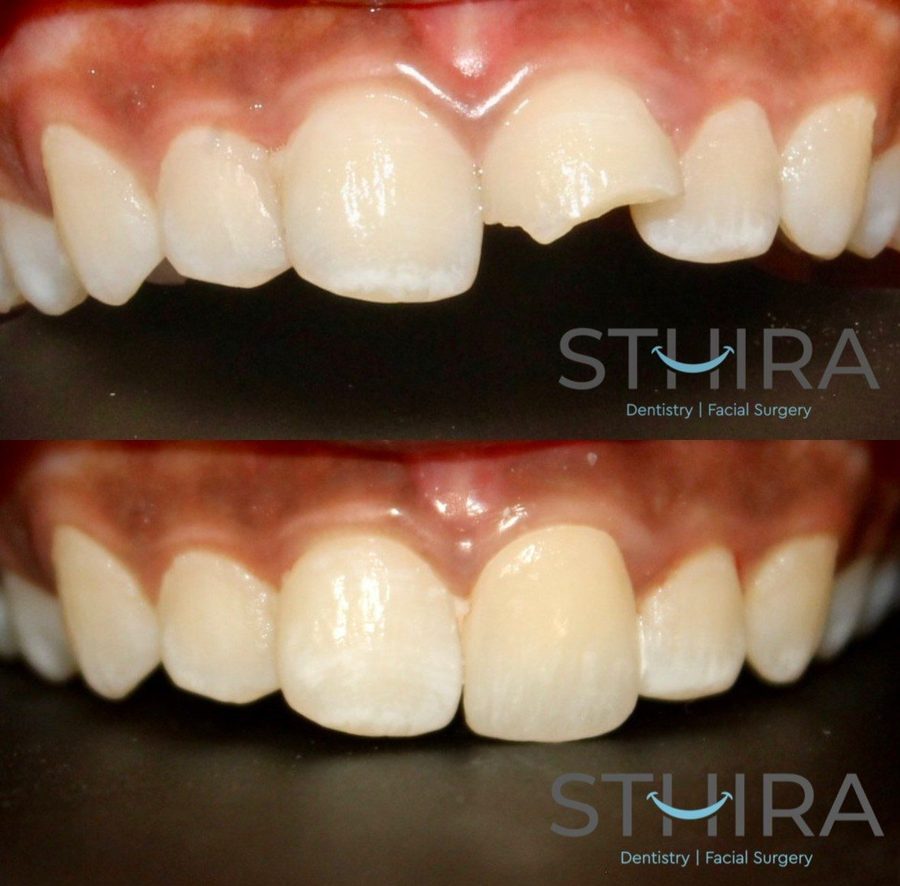 Dental Implants at STHIRA, Raidurg