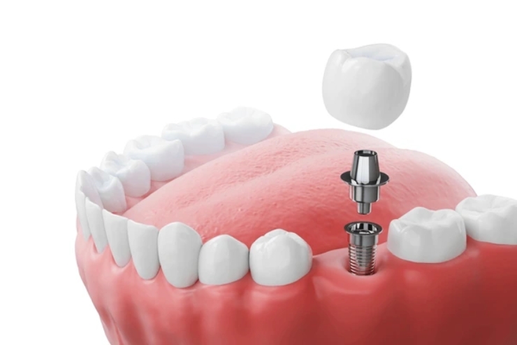 Dental Implants,